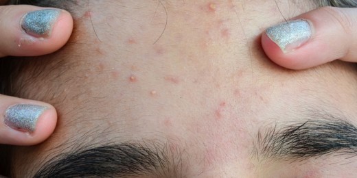 Maladie de peau très fréquente, l'acné touche plus de 80 % d’adolescents dans le monde entier